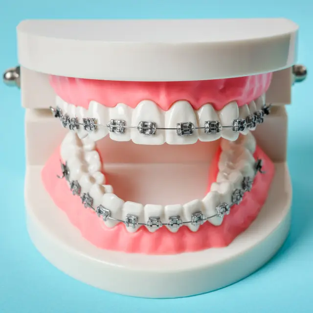 Zahnversicherung bei Implantaten, Kronen und Inlays – was wird übernommen, was nicht?